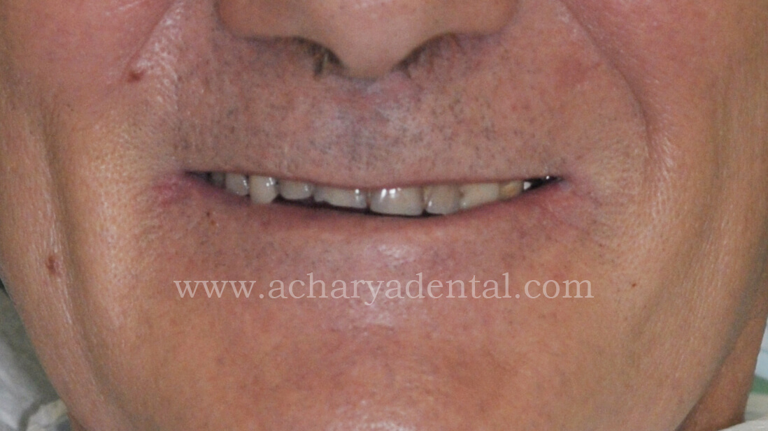 Denture Pre
