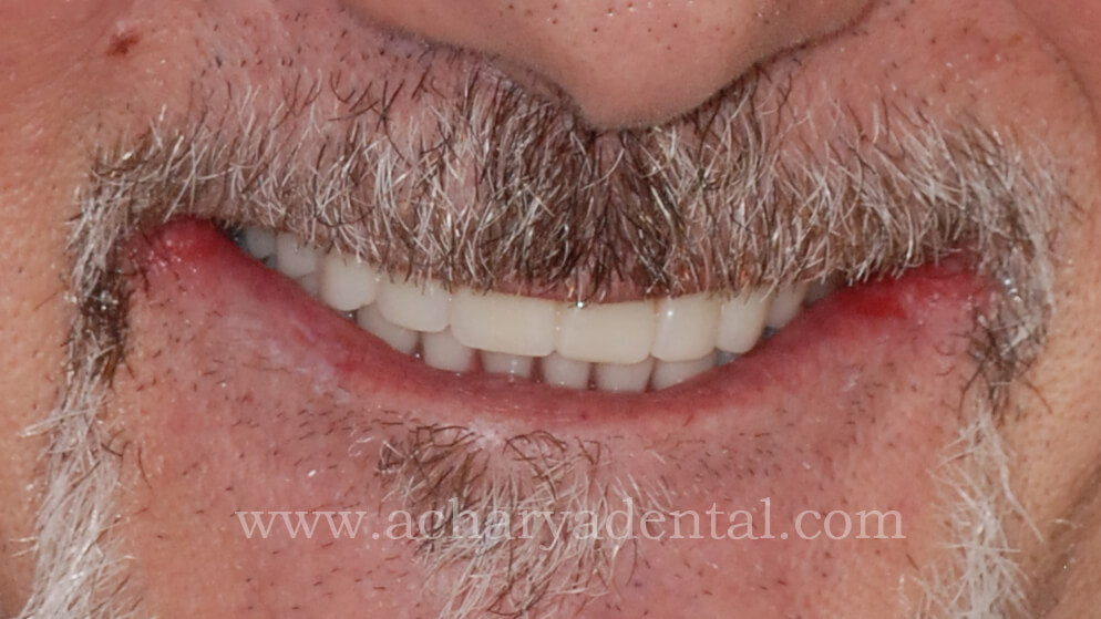 Denture Post