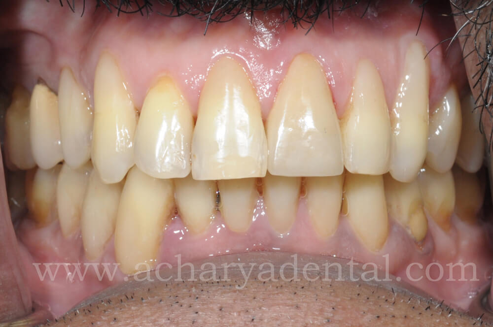 After Fillings