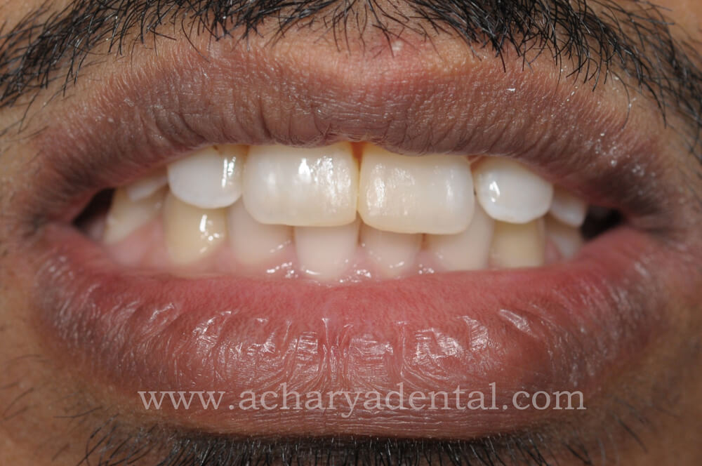 After Fillings Treatment