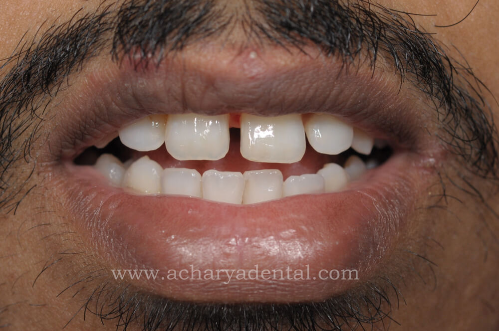 Before Fillings Treatment