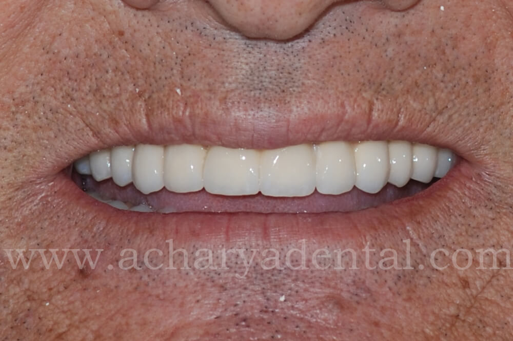 Full Mouth Rehabilitation Post