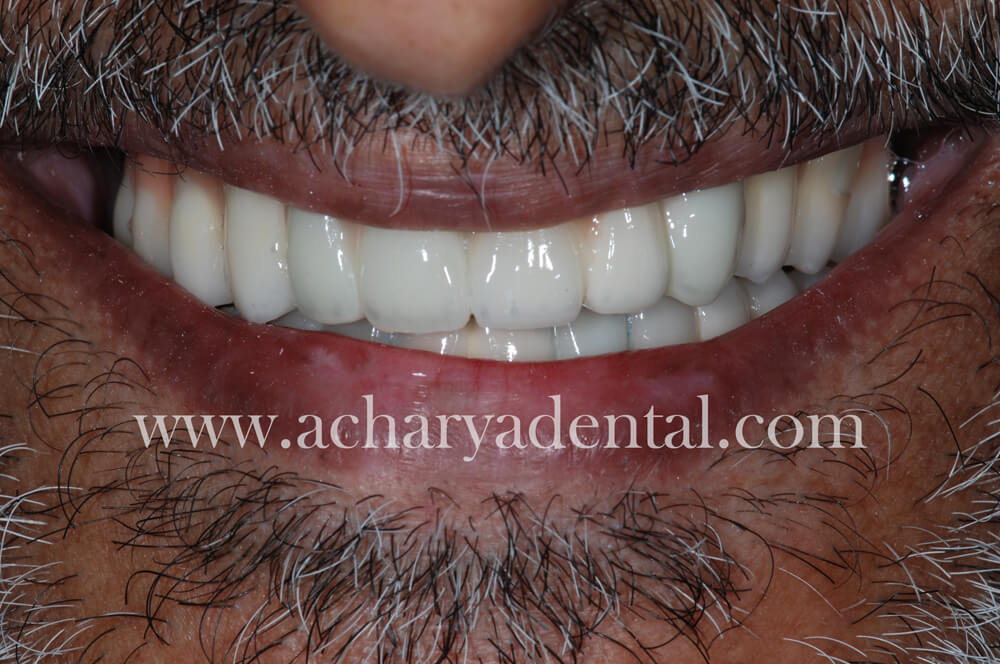 Post Full Mouth Rehabilitation