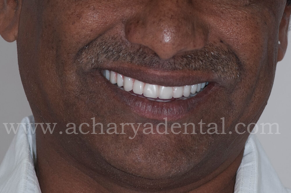 After Treatment Full Mouth Rehabilitation