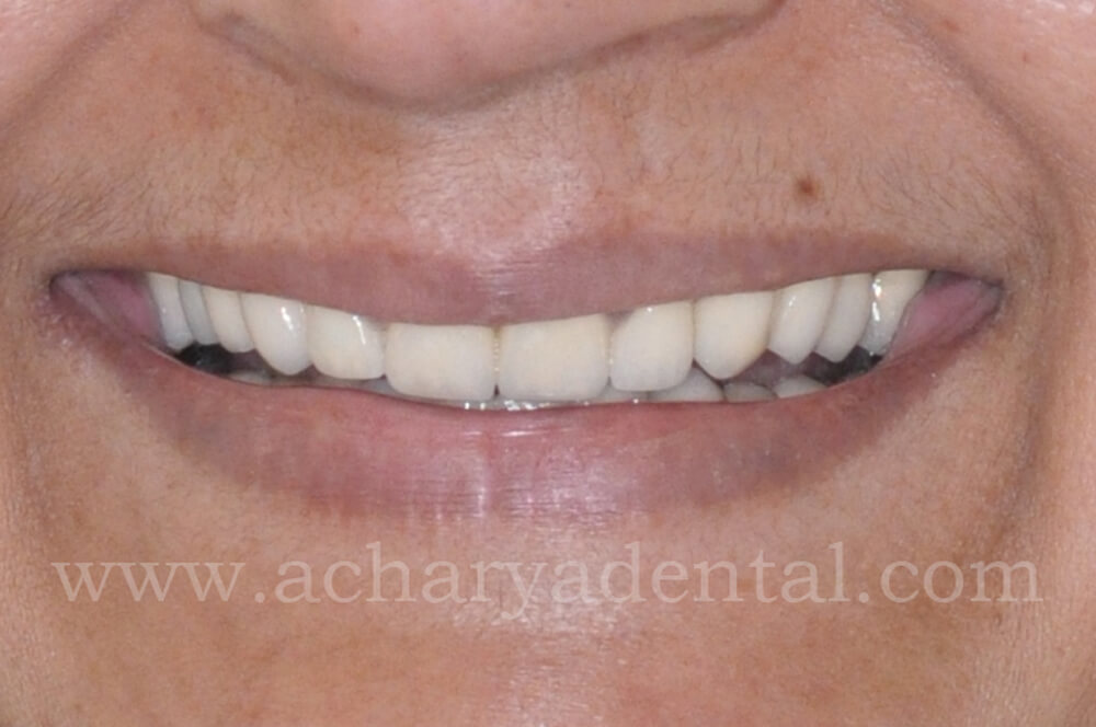 After the treatment Full Mouth Rehabilitation