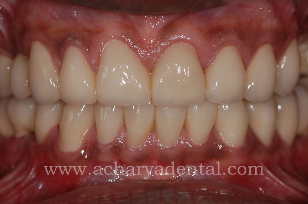Postmouth rehabilitation
