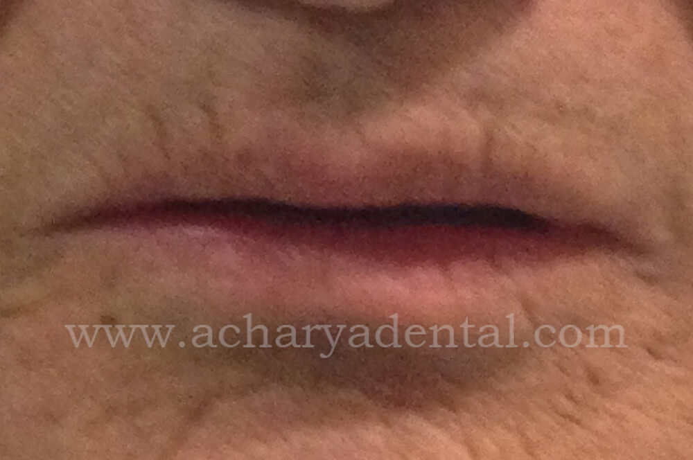 Full Mouth Rehabilitation Pre