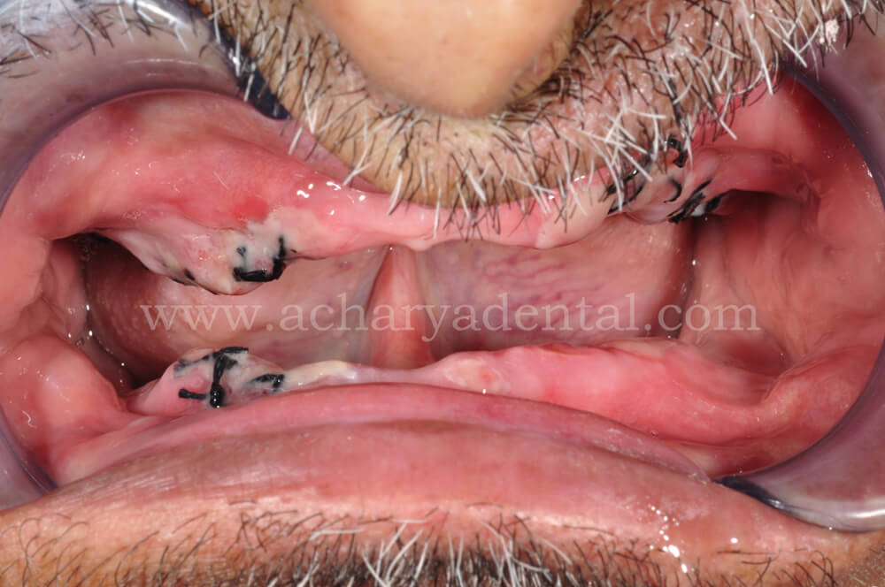 Pre Full Mouth Rehabilitation