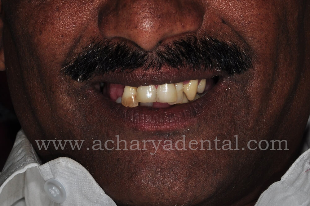 Before Treatment Full Mouth Rehabilitation