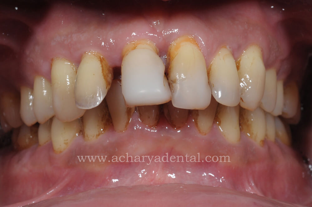 Mouth Rehabilitation Before