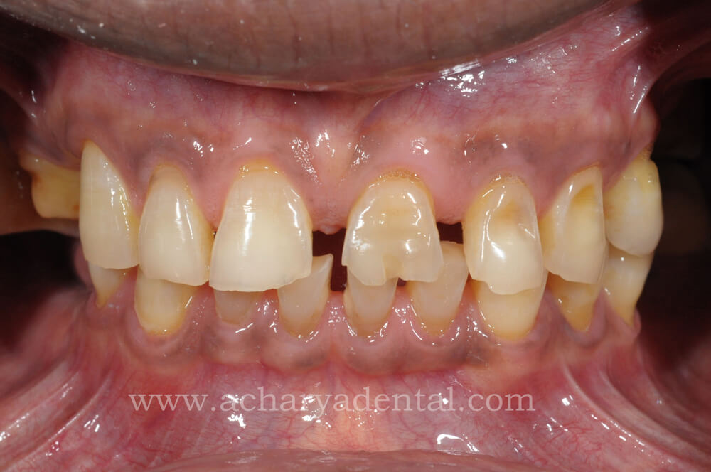 Premouth rehabilitation