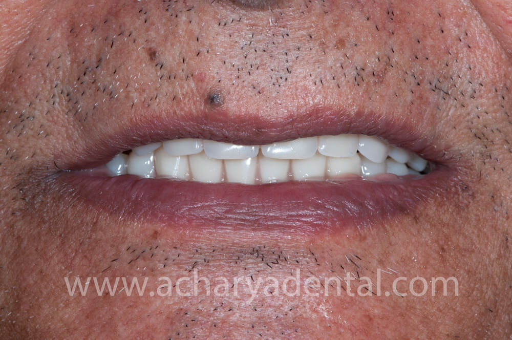Post Denture