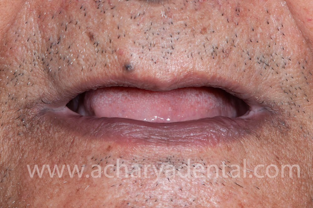 Pre Denture