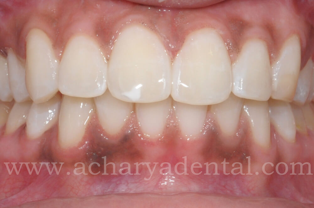 Teeth Whitening After