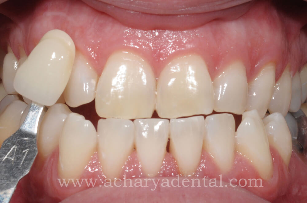 Whitening Treatment After