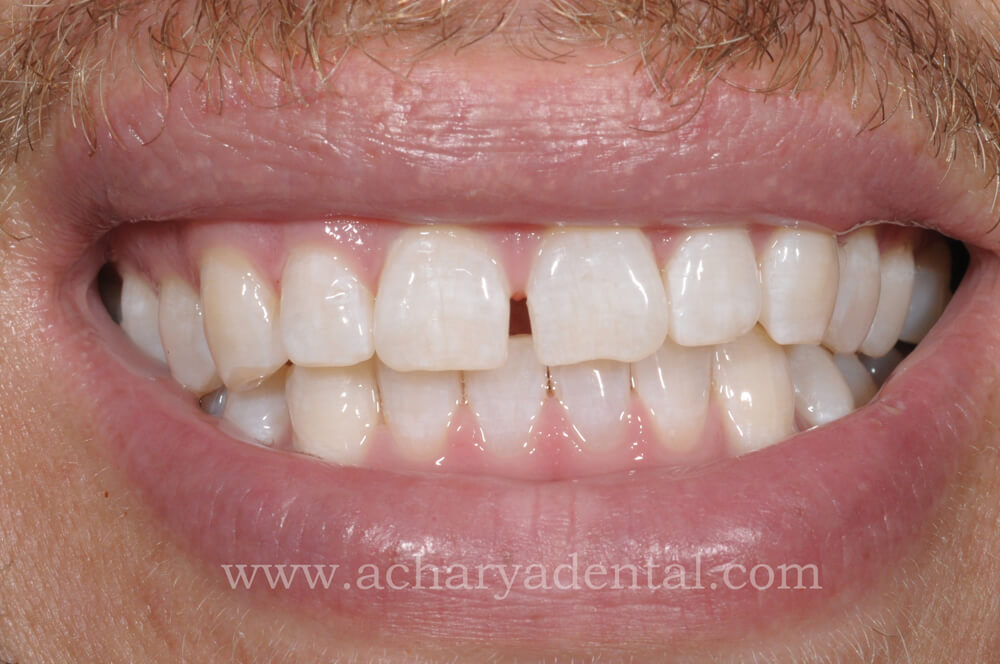 After Whitening Treatment
