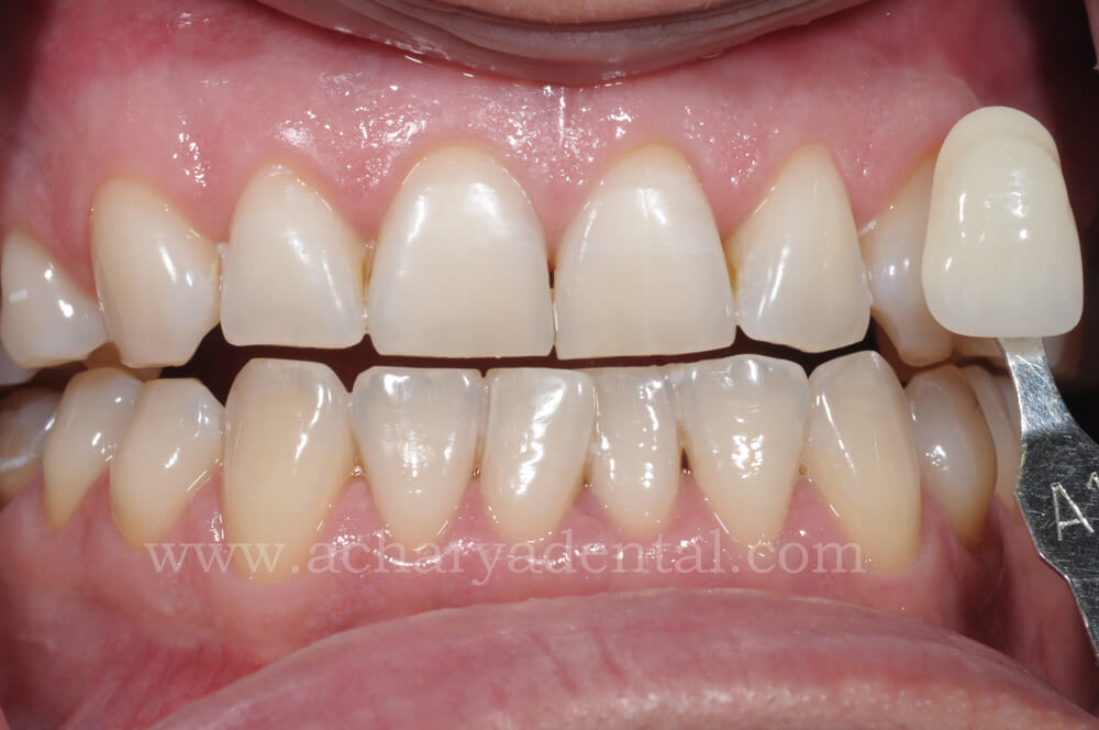 Teeth Whitening After Treatment