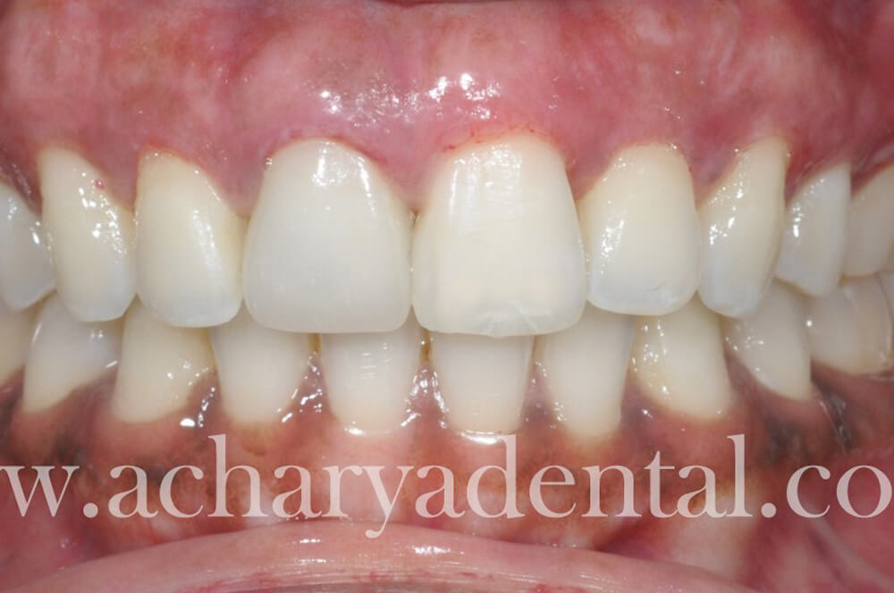 Whitening Post Treatment