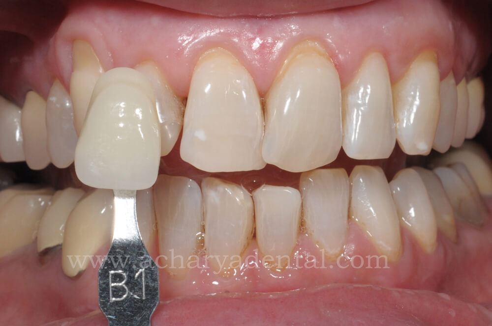 Post Teeth Whitening