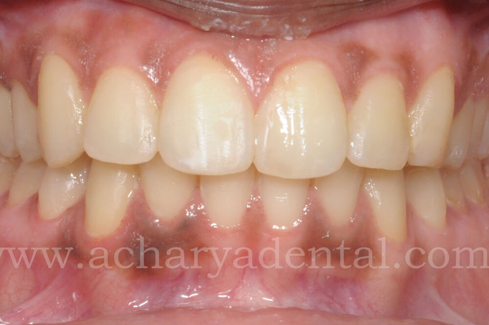 Teeth Whitening Before