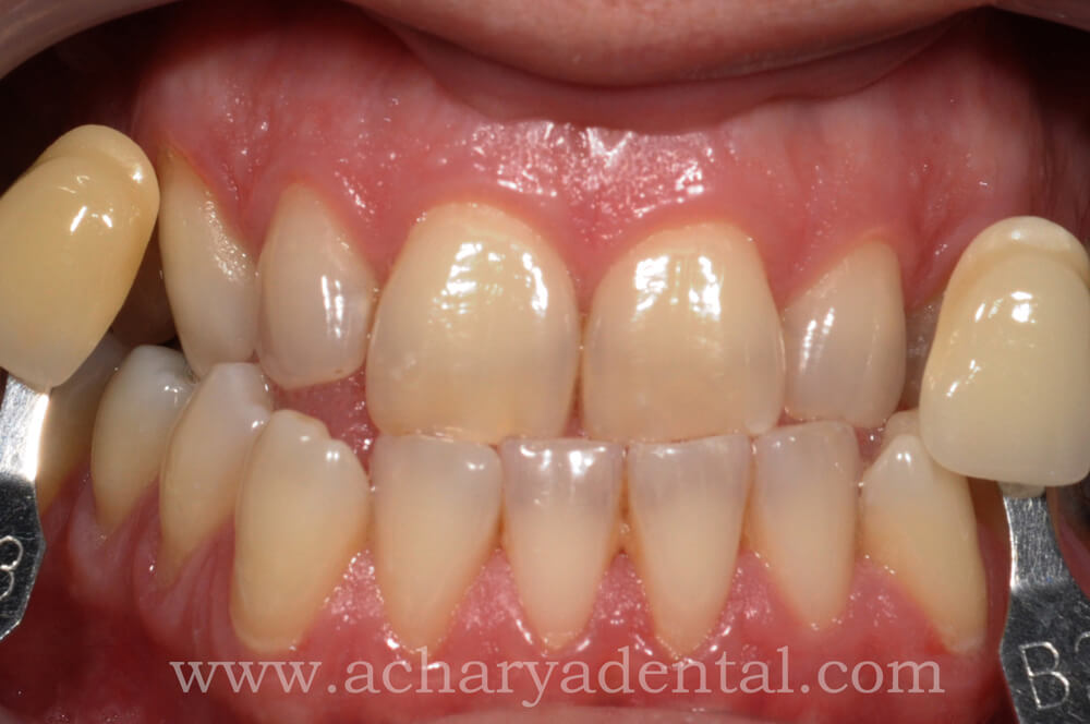 Whitening Treatment Before