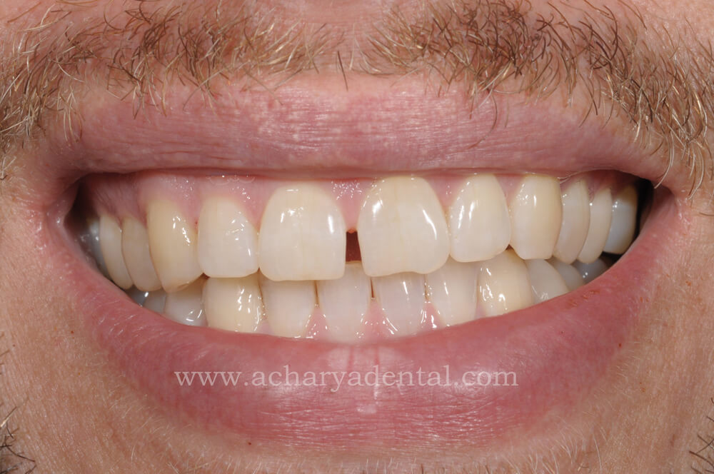 Before Whitening Treatment