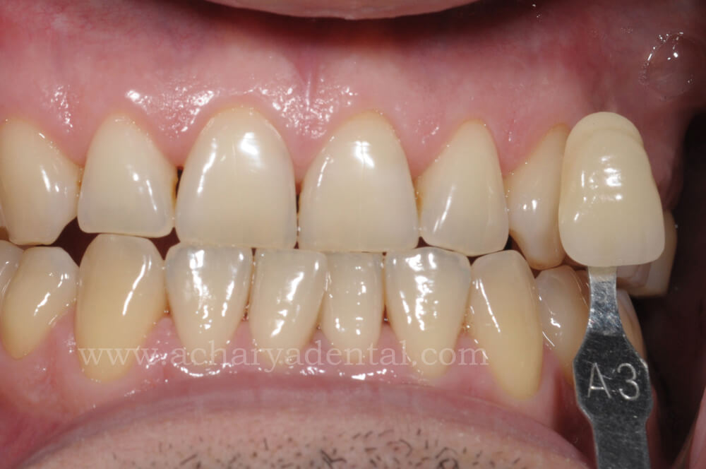 Teeth Whitening Before Treatment