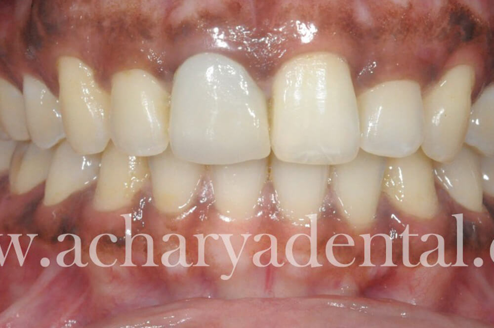 Whitening Pre Treatment