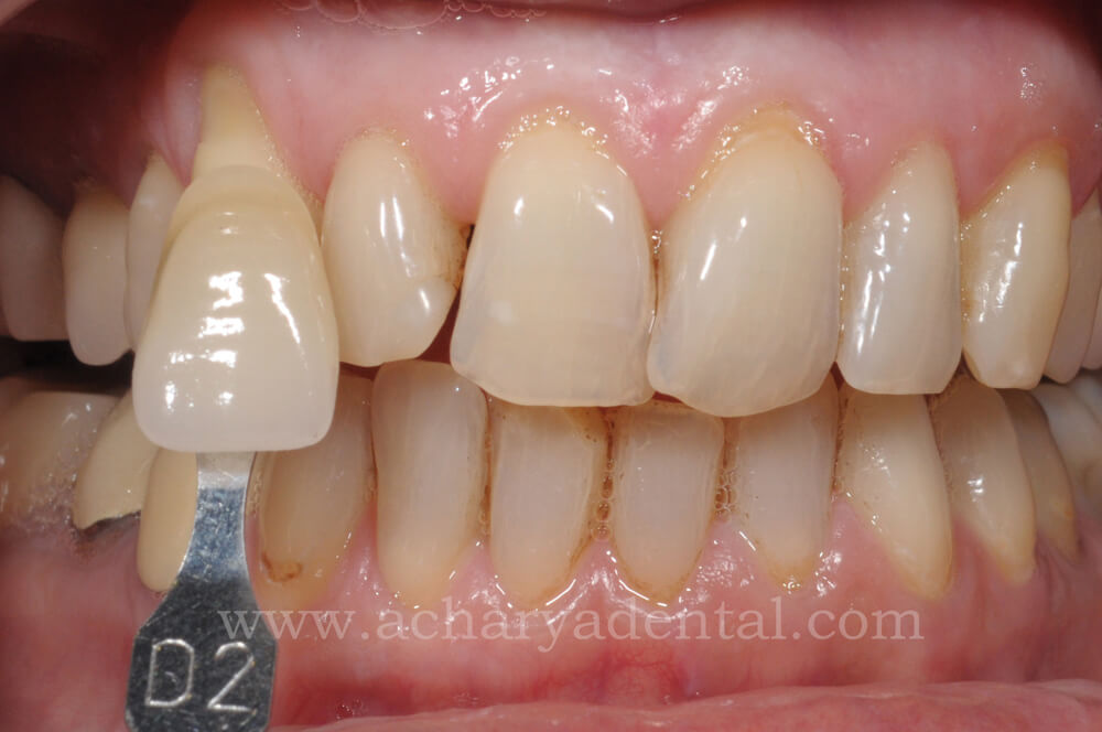 Pre Teeth Whitening