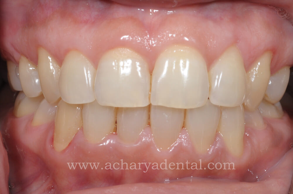 teeth cleaning after