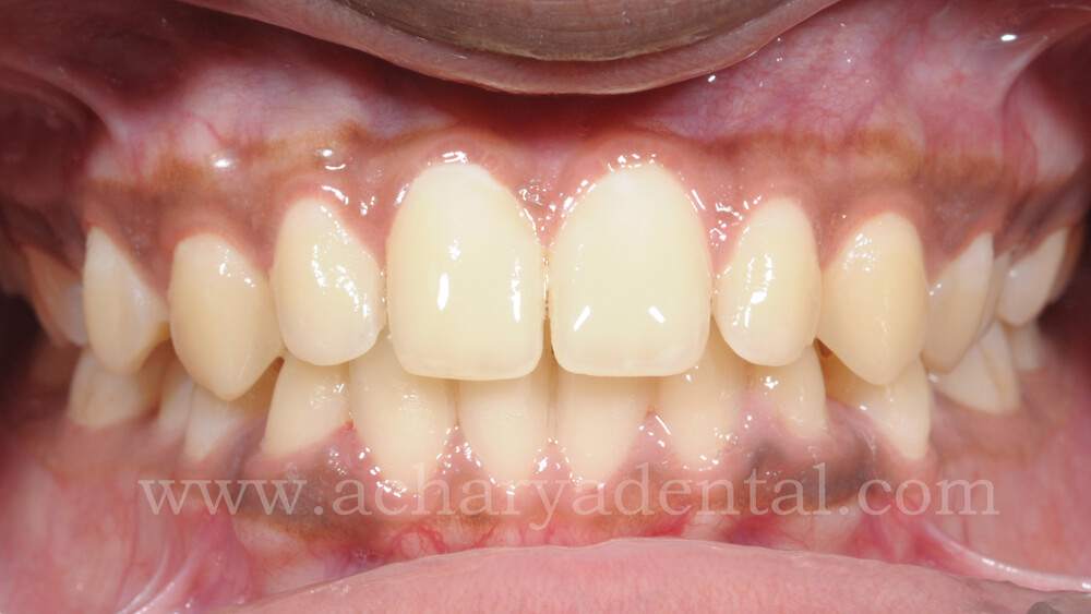 after cleaning teeth