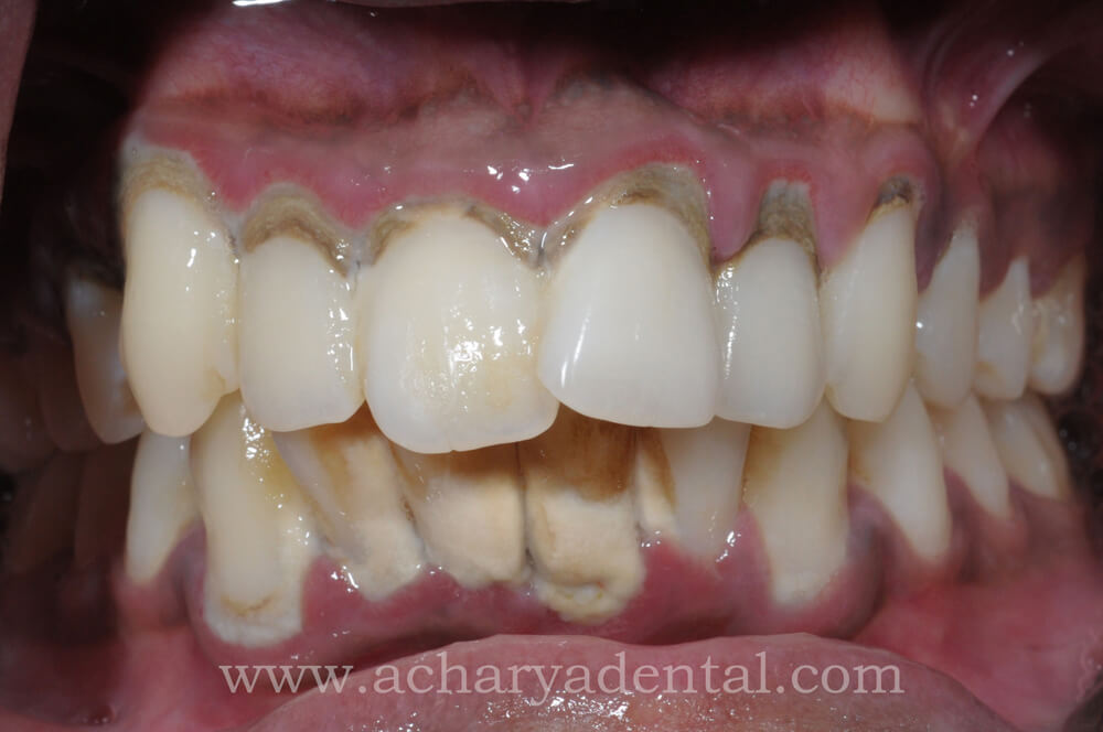 teeth cleaning before treatment