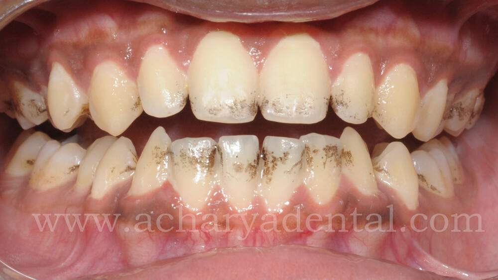 before cleaning teeth