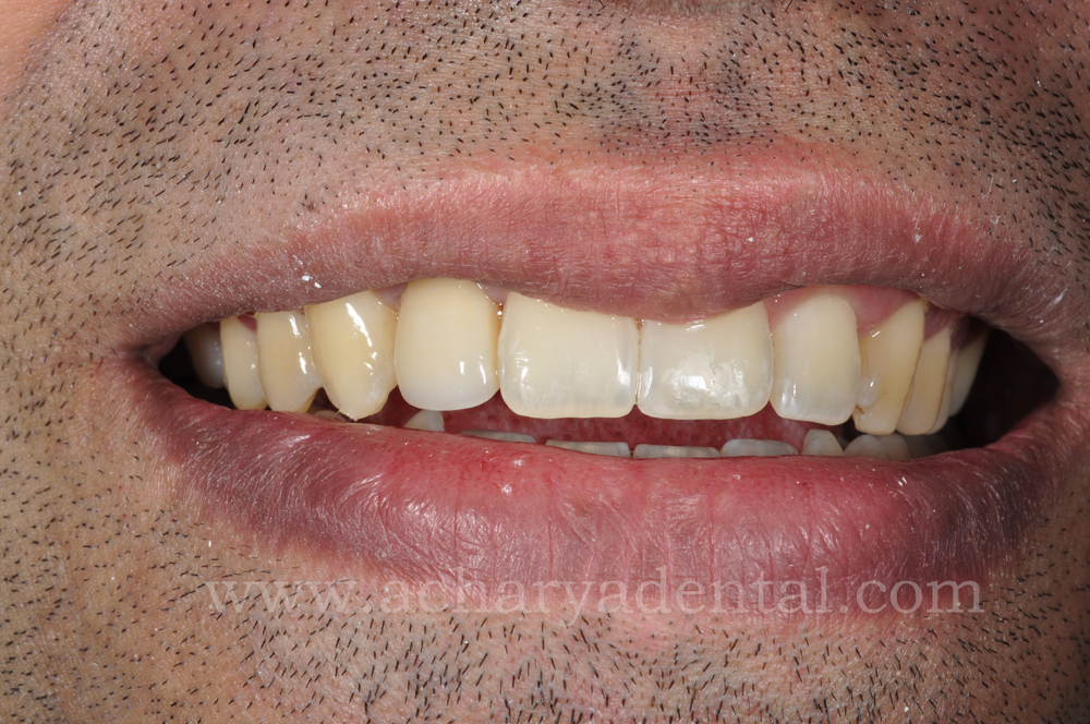 Pre tooth replacement crown