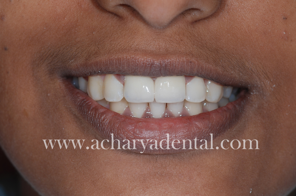 Tooth Replacement Crown after treatment