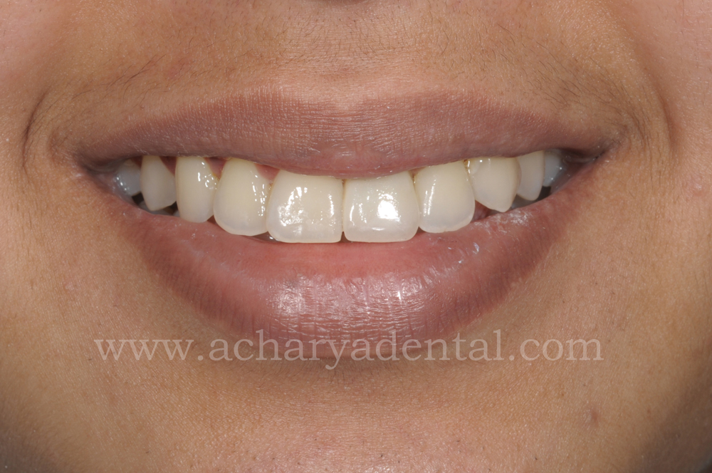 Tooth Replacement Crown post treatment
