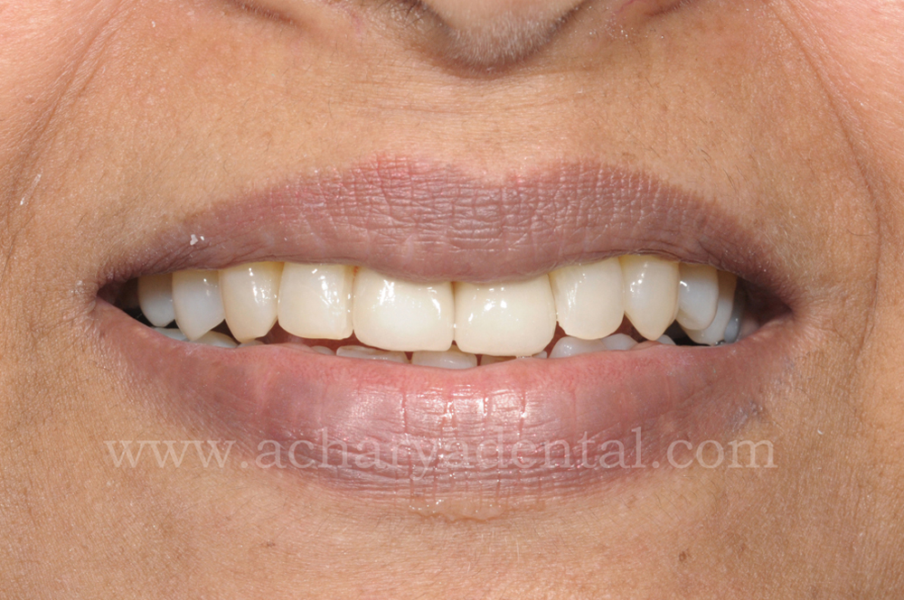Before Tooth Replacement Crown