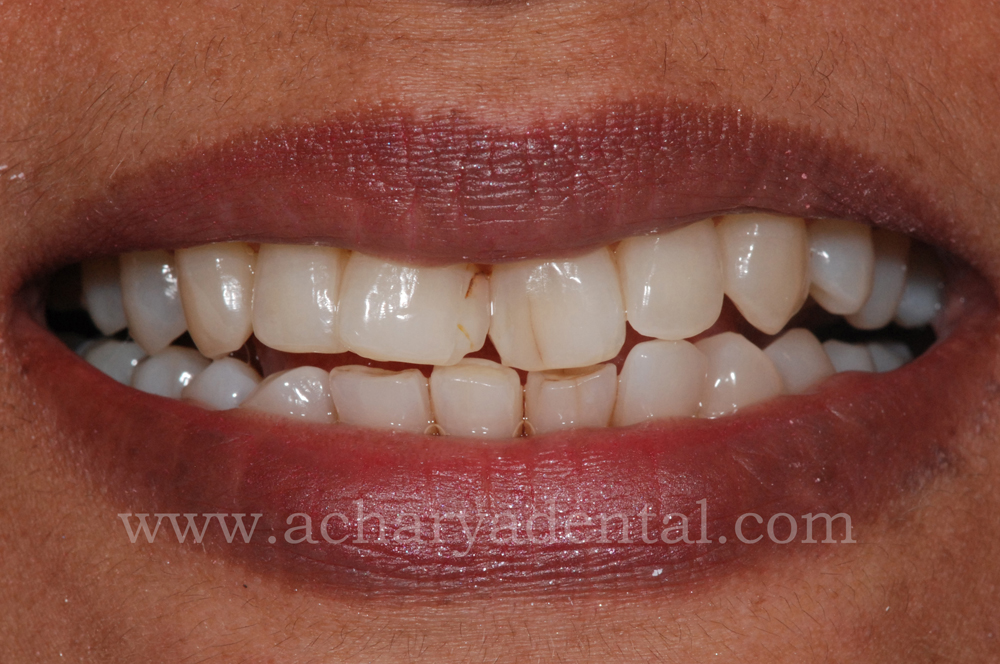 After Tooth Replacement Crown