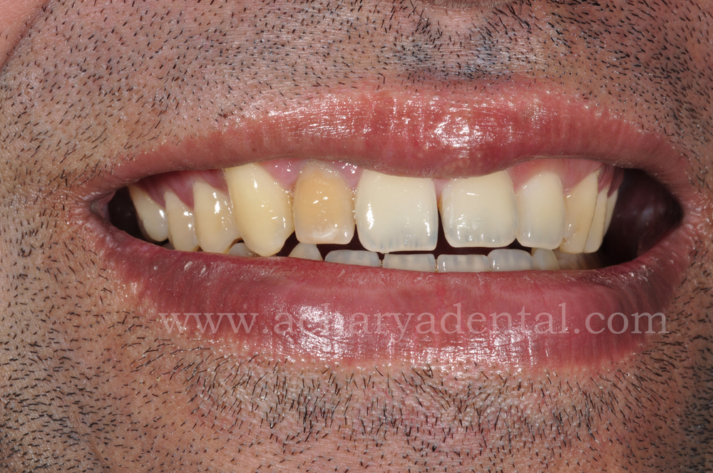 Post tooth replacement crown