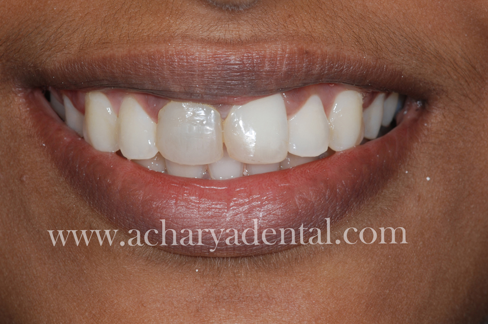 Tooth Replacement Crown before treatment