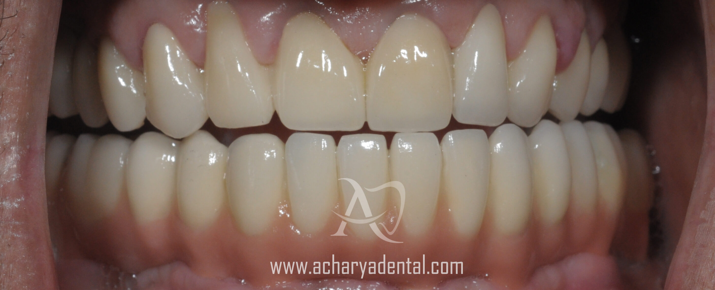 after full mouth rehabilitation