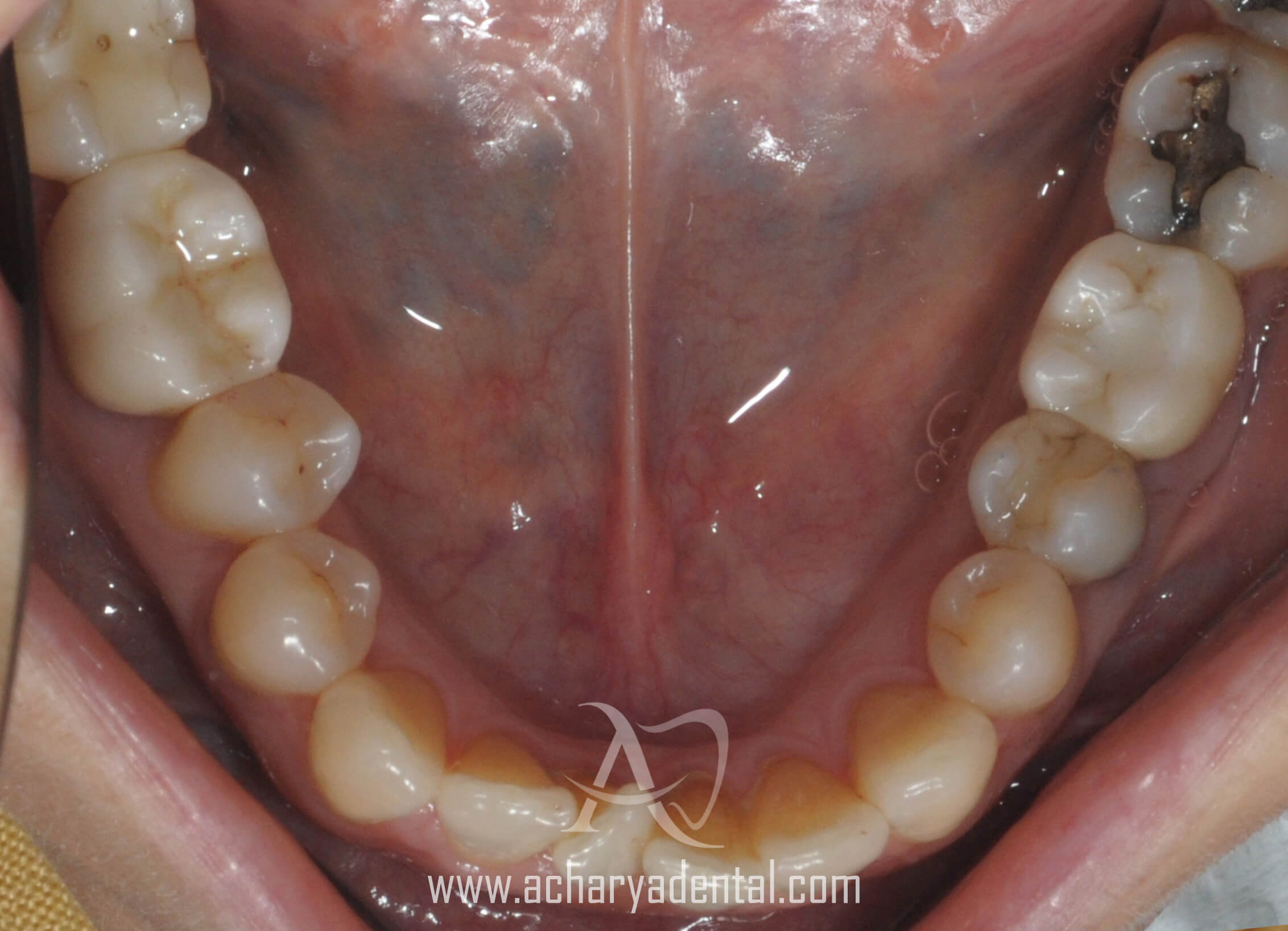 after dental implant treatment