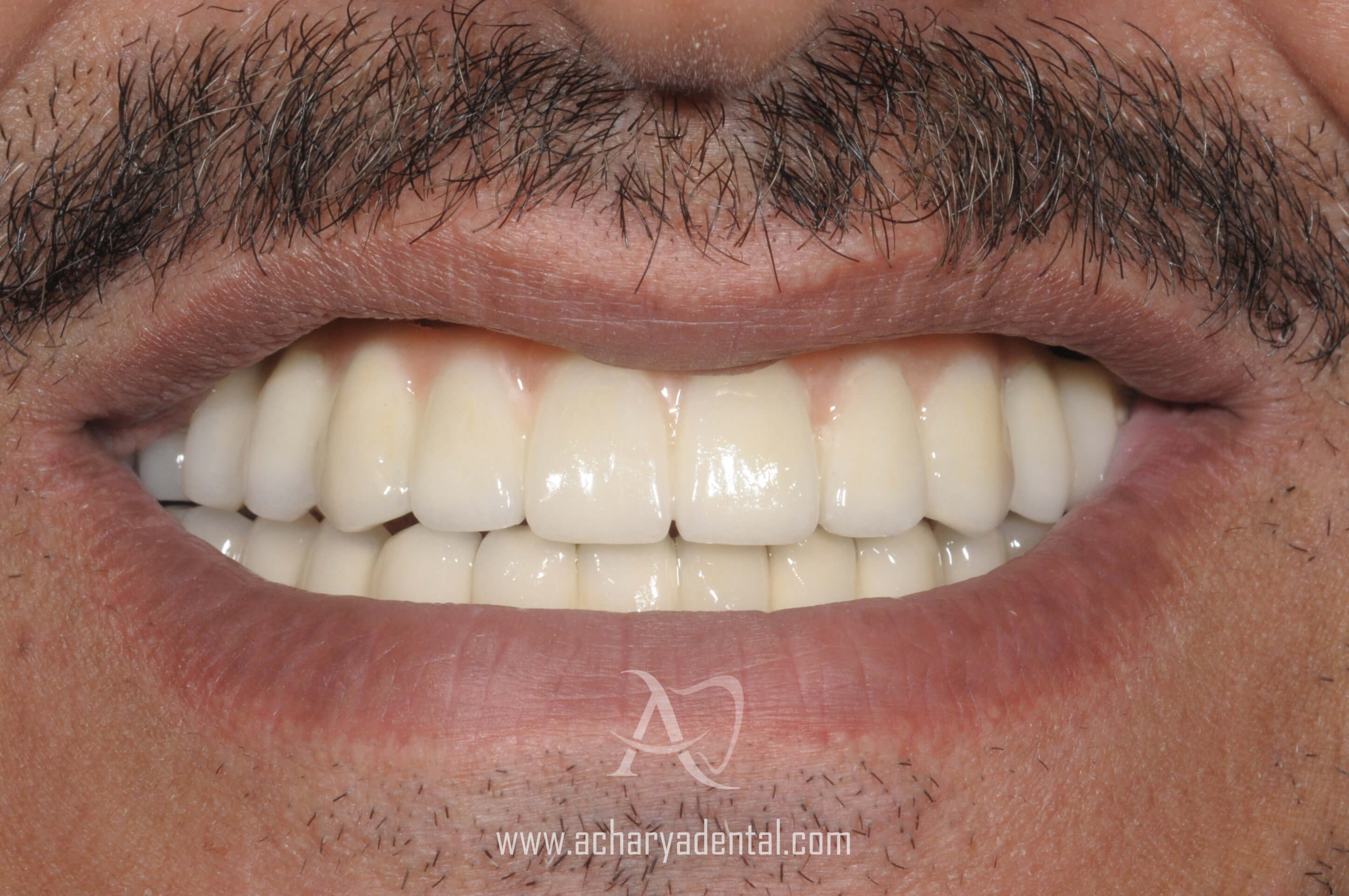 after dental implant