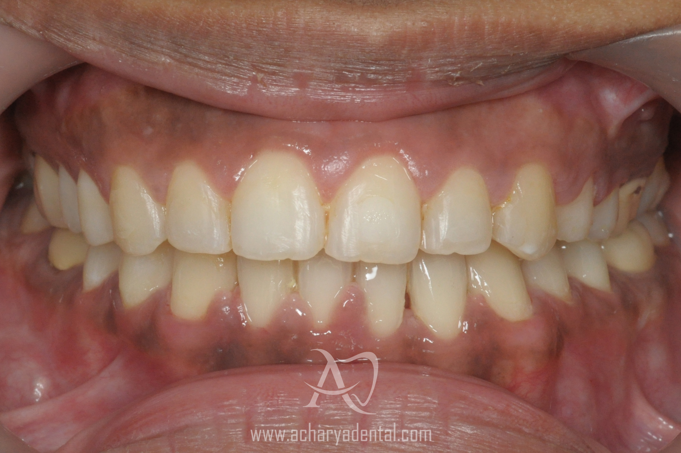 after ortho treatment