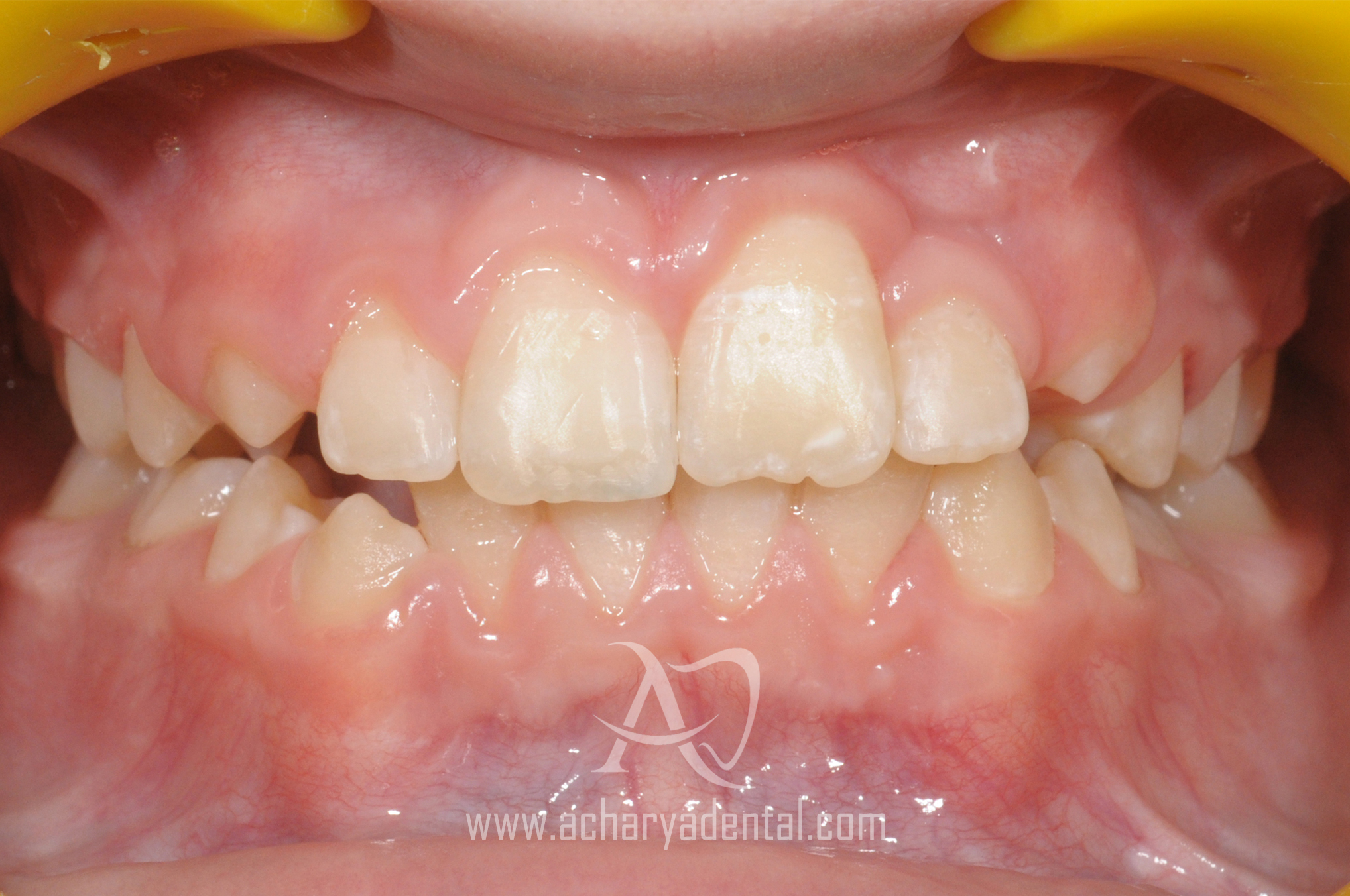 after orthodontics
