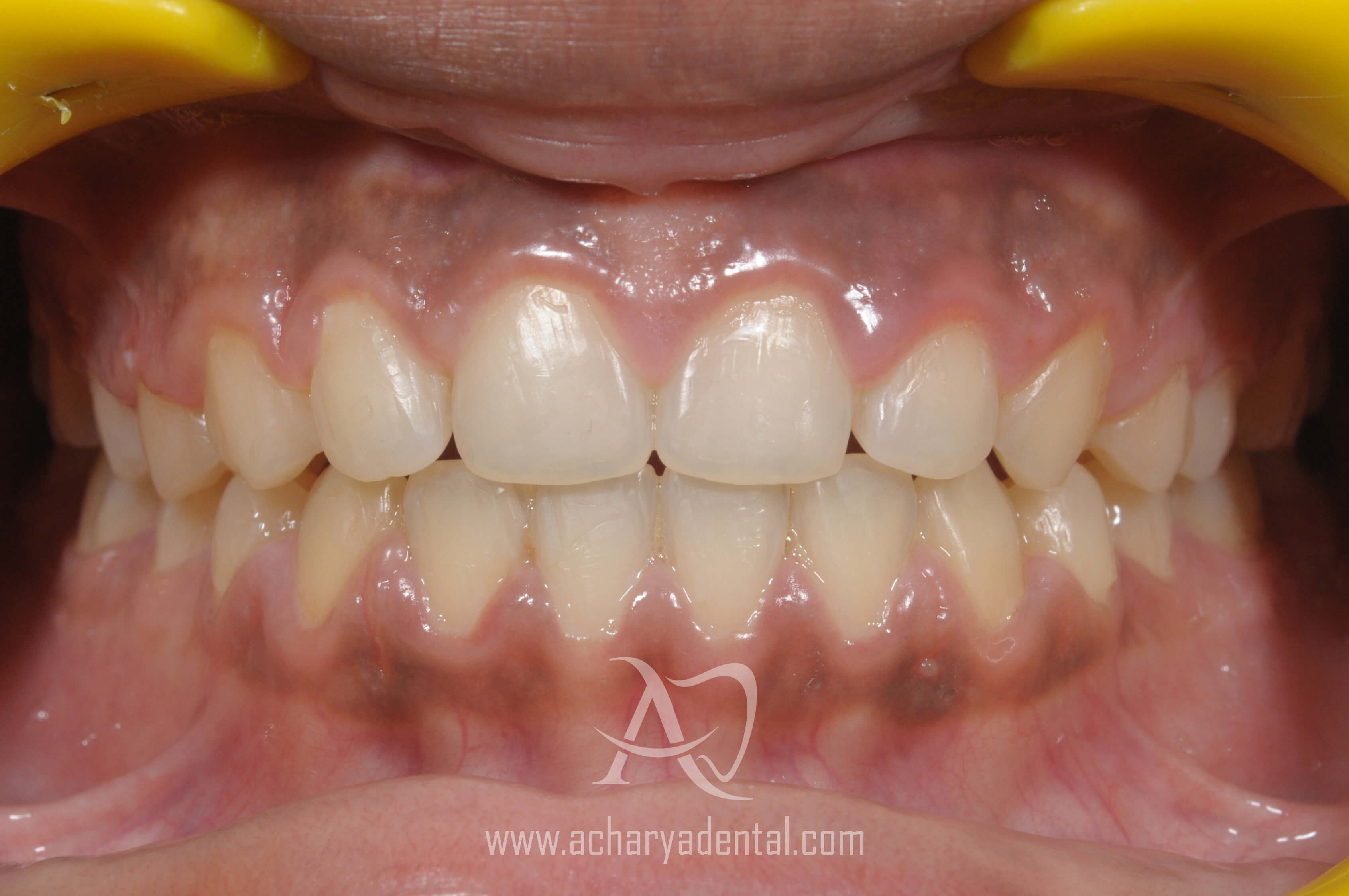 after orthodontics