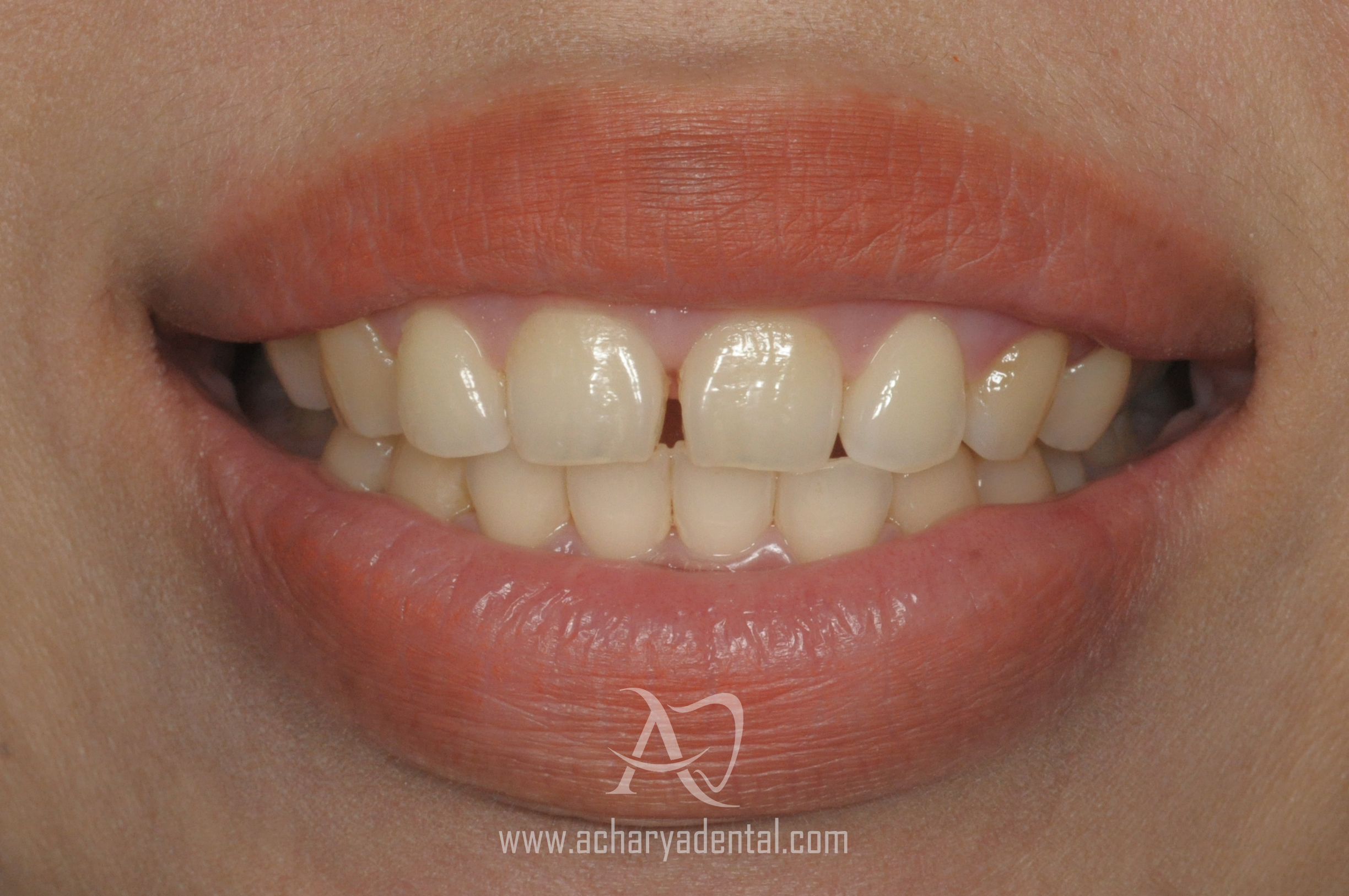 after smile make over