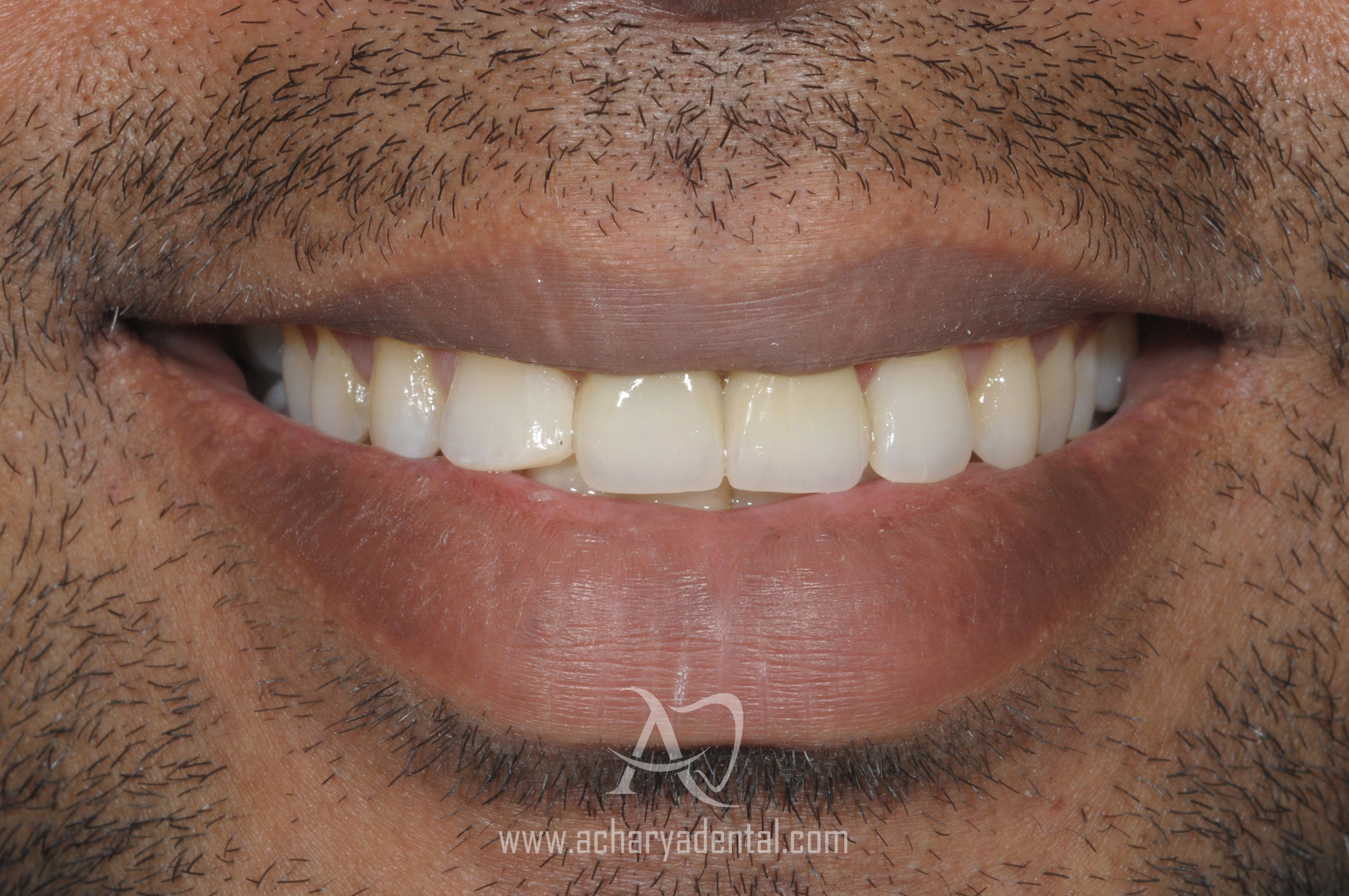 after smile makeover diagnosis