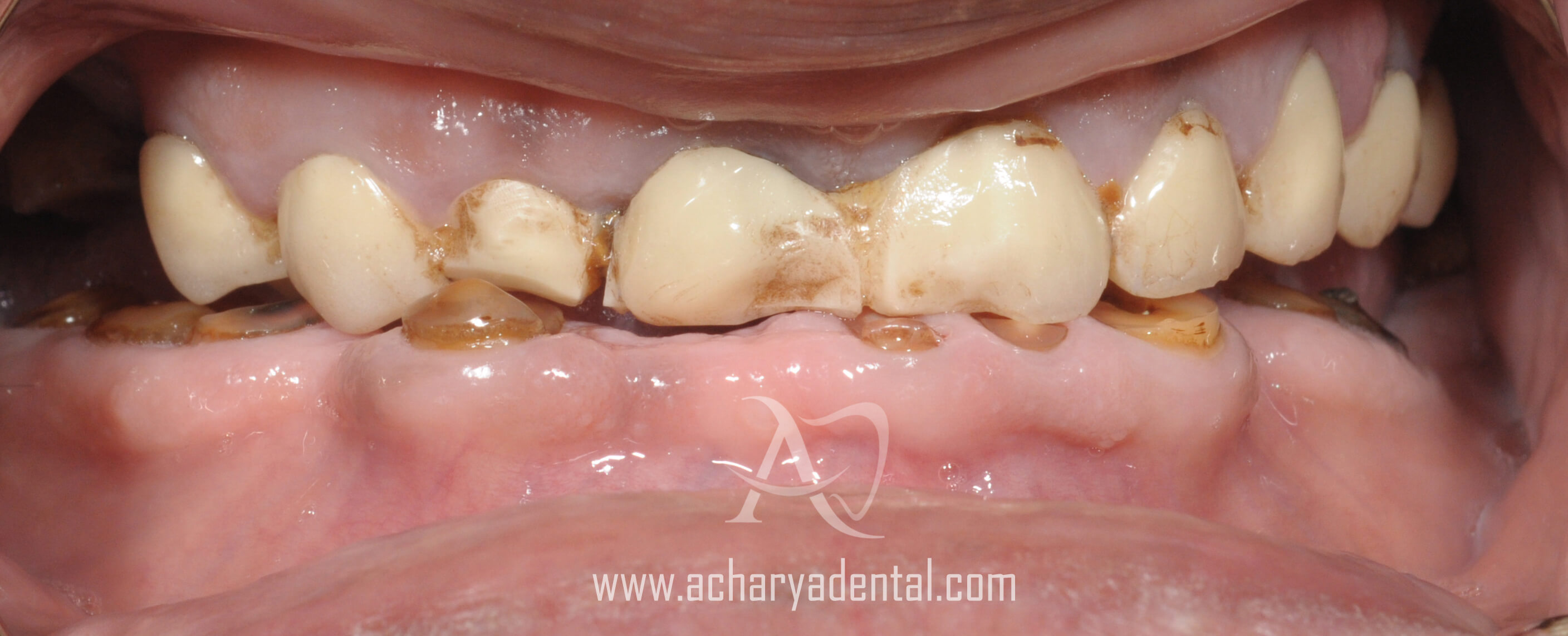 before full mouth rehabilitation