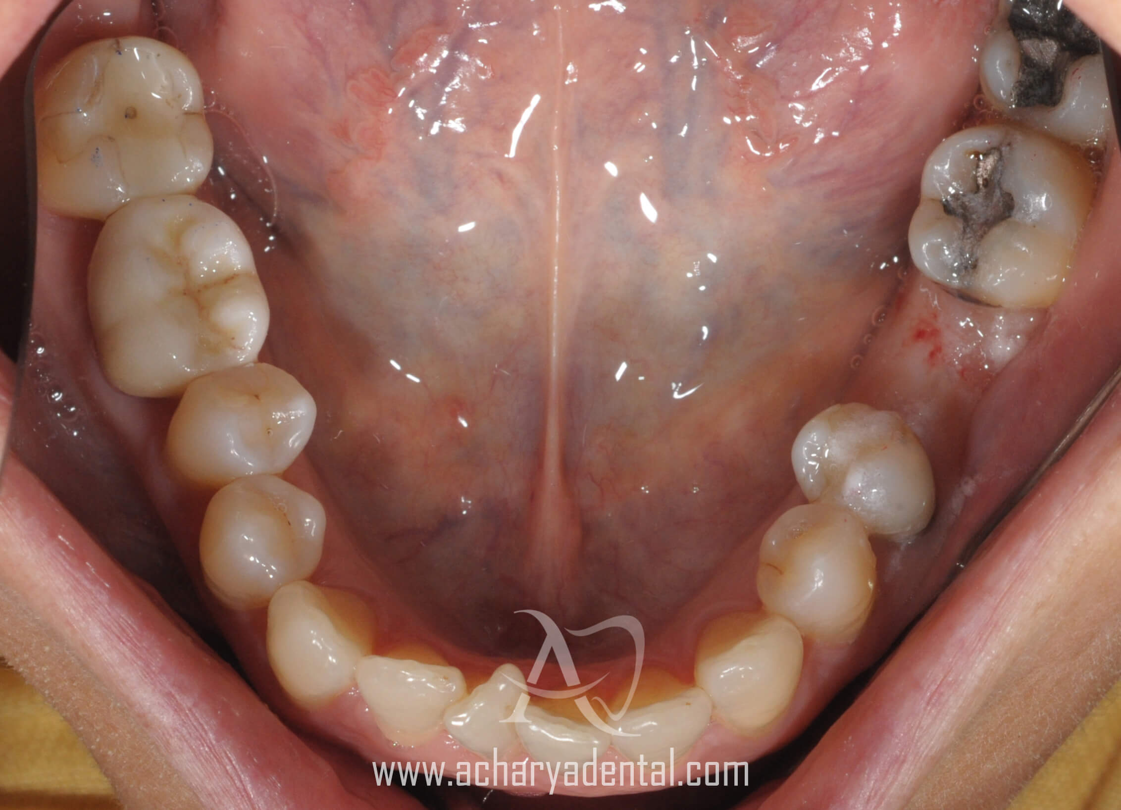 before dental implant treatment